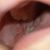 Me hice una bichectomia