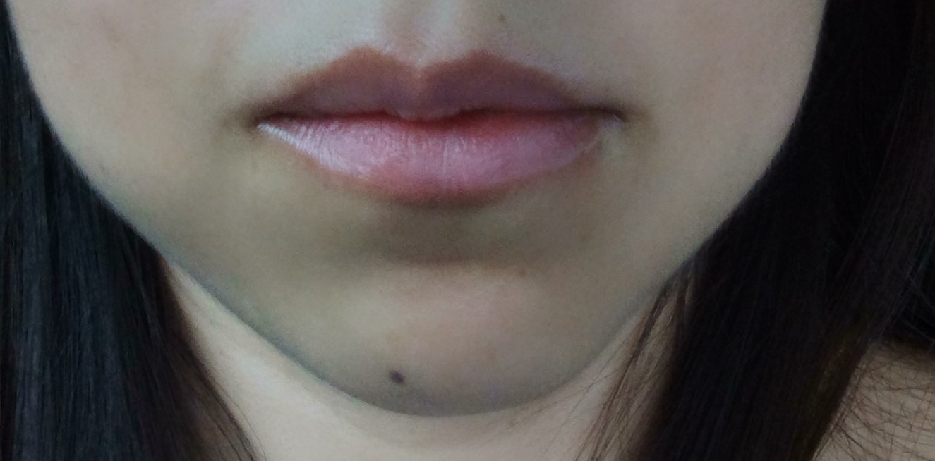 La bichectomia me ha dado unos pómulos más marcados y unas mejillas más