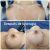 Aumento  de busto 410cc