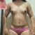 ¡Cambio mi cuerpo y mi autoestima la abdominoplastia!