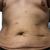 Abdominoplastia, Liposuccion, gynecomastia, lipo transferencia - Daddy makeover