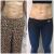 Abdomen con radiofrecuencia