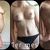 Abdominoplastia y aumento de senos 