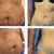 Excelentes resultados de mi Abdominoplastia