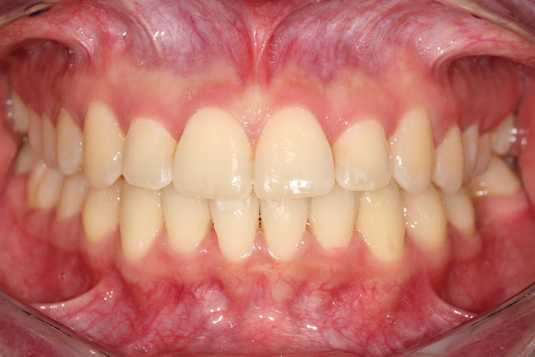 Dientes derechos en menos tiempo con brackets transparentes