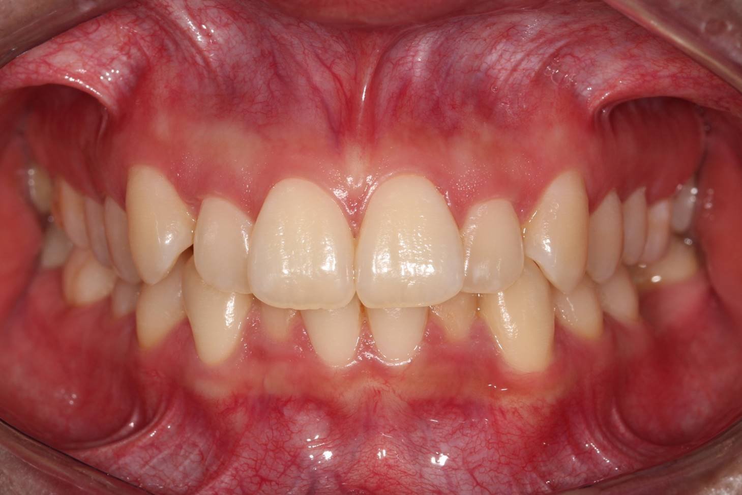 Dientes derechos en menos tiempo con brackets transparentes
