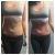 Radiofreuencia Venus Legacy en abdomen