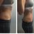 Radiofreuencia Venus Legacy en abdomen
