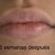 Aumento de labios en Morelia