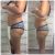 Venus reafirmante en abdomen - Radiofrecuencia