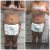Venus reafirmante en abdomen - Radiofrecuencia