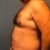 Marcación abdominal en hombre, Coyoacán Dr. Camacho