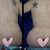 Abdominoplastia, un excelente doctor!