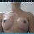 Aumento de busto, implantes Eurosilicone 550CC, Submuscular perfil extra alto