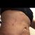 Me hice una lipo con bodytite en mi abdomen