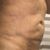 Me hice una lipo con bodytite en mi abdomen