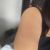 Braquioplastia mal hecha