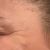 Hilos tensores me hizo fibrosis 