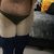 Liposuccion, abdominoplastia y bbl