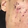 CICATRICES ACNE TRAMIENTOS ALTERANTIVOS 