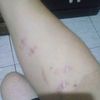 Quitar cicatrices por diferentes metodos