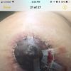 Miedo de cómo quede mi areola 