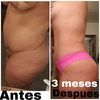 Mis resultados después de una liposucción!!