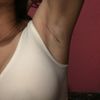 Incisión axilar? Como les ha ido con ella???