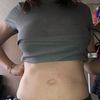 Mis resultados sobre mi aumento de busto, y lipotransferencia 