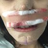 Mentoplastia interno y Rinoplastia 