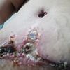 Terapia vac en herida de abdominoplastia