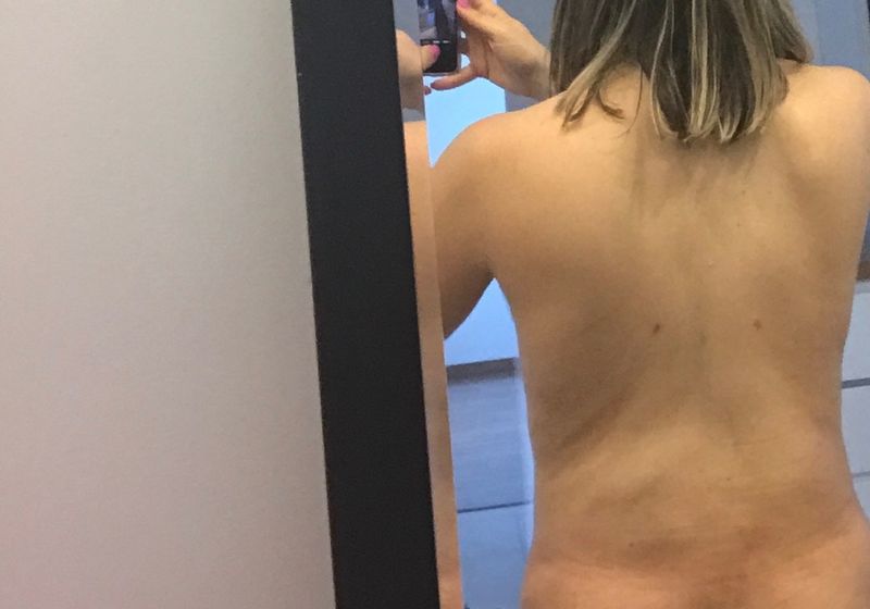 dieta despues de una abdominoplastia dieta despues de una abdominoplastia