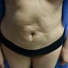 Quitar fibrosis secundaria abdominal con medicamentos 