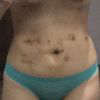 Ayuda!!  Me hice la lipo y aún no veo grandes resultados!!!