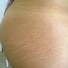 Traumada con mis estrias