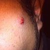 Busco una 2a opinión sobre cauterización de verruga 
