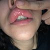 Polímeros en los labios