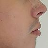 Rinoplastia de nariz