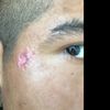 Quiero eliminar o minimizar una cicatriz de mi cara¿algún tipo de cirugía me puede ayudar?