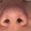 Rinoplastia en nariz ancha y piel gruesa
