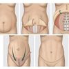 Calendario Abdominoplastia NOV - DIC 🔥