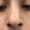 Ácido Hialuronico sobre nariz con Rinoplastia