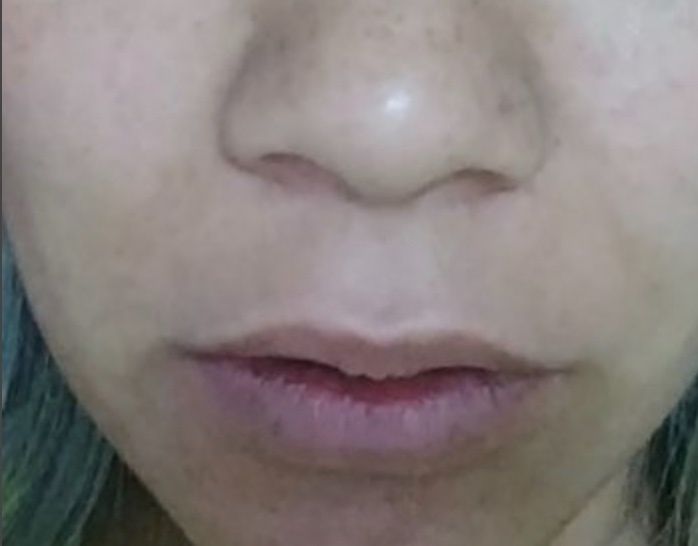 rinoplastia gestation hocico ancha