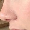 Rinoplastia para nariz ancha