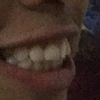 Mover dientes sin brackets 