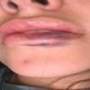 Hematomas por aumento de labios