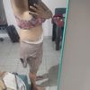 Asimétria después de lipo