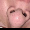 Acido hialuronico en la nariz