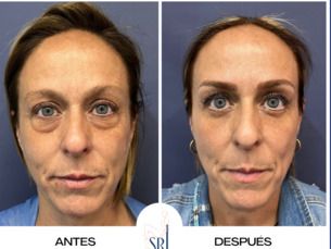 Blefaroplastia a $24,999. pesos M.N.
