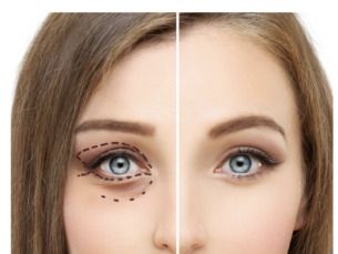 Blefaroplastia Superior de $18,000 a $12,500